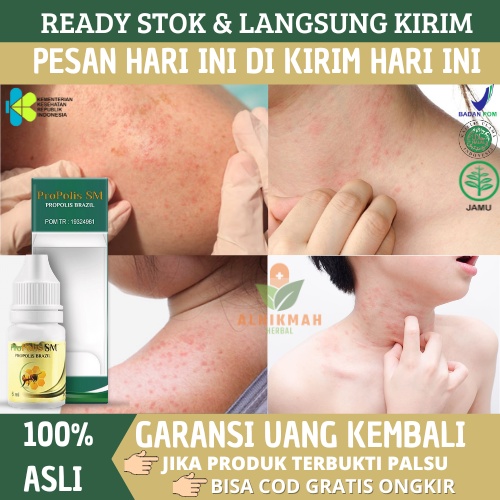 Obat Biang Keringat Anak dan Dewasa, Obat Penghilang Biang Keringat, Obat Biang Keringat, Obat Milia