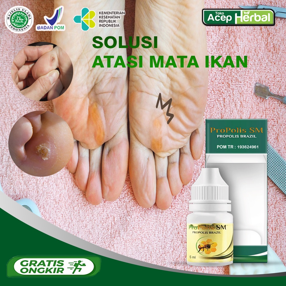 Obat  penyakit mata ikan - obat mata ikan di kaki - obat mata ikan di tangan - Obat kutil kaki - oba