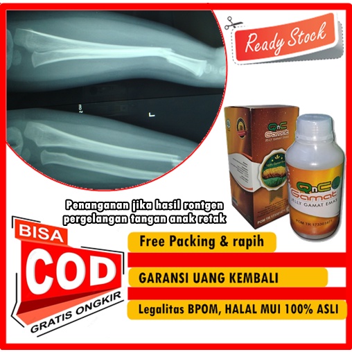 Penanganan jika hasil rontgen pergelangan tangan anak retak | Obat Retak pada tulang atau patah tula