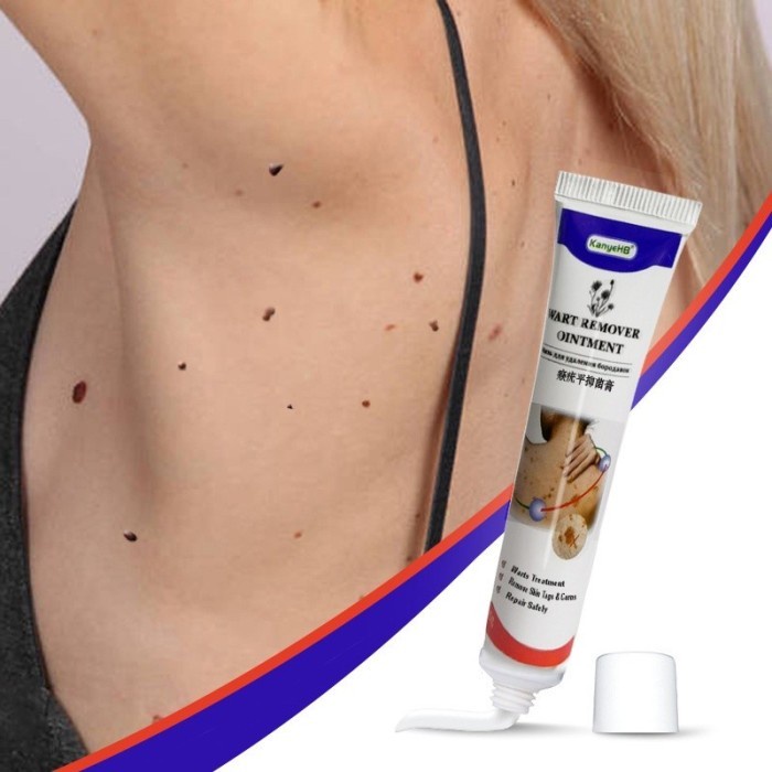 FMFIT Obat Salep Penghilang Tahi Lalat Kutil Mata Ikan mole wart skin tag