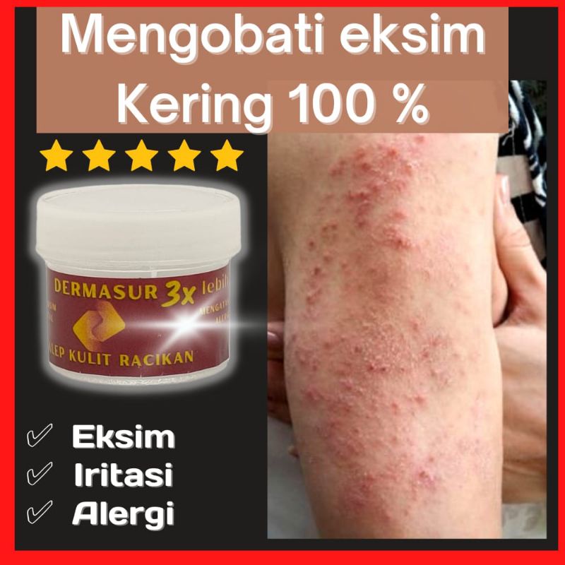 Jual Dermasur Obat Salep Eksim Kering Ampuh Basah Gatal Gatel Kulit