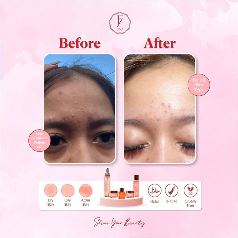 Paket Frizy  Brightening Day Acne Series Skincare berjerawat glowing BPOM HALAL