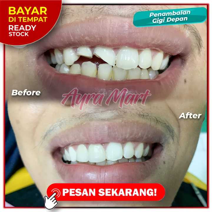 ANTI KUNING  KUAT PERMANEN  Super kuat penambal gigi ompong Tambal gigi bolong permanen original Gigi palsu penutup gigi ompong bolong patah jarang carang renggang Gigi palsu permanen kuat tahan lama pria wanita Gigi palsu snap on smile asli Temptooth