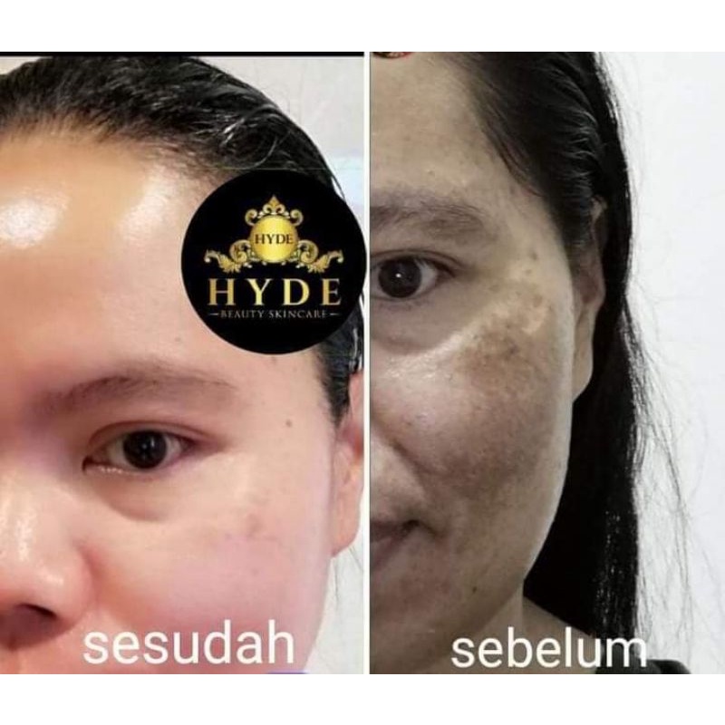 [FREE GIFT] HYDE SKINCARE PAKET GLOWING ISI 5 FORTE | SERUM LEMON / SERUM SAKURA