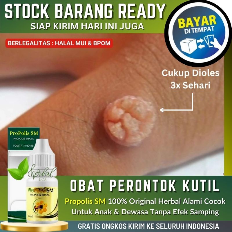 ProPolis SM Brazil - Obat Oles Untuk Perontok Kutil Di Kepala / Tangan / Leher / Kaki