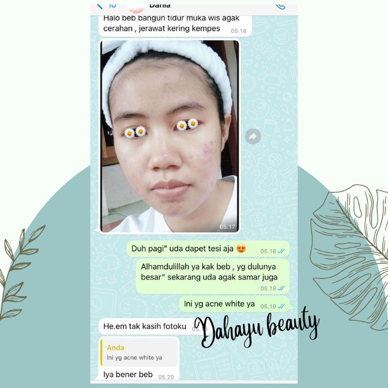 CREAM MALAM ACNE WHITENING 35.000