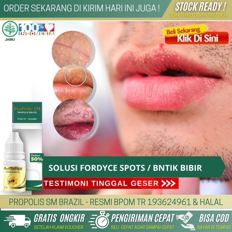 Obat Alami Bibir Bintik Putih, Obat Penghilang Ruam Dekat Bibir, Obat Alergi Bibir Bengkak Gatal, Ob