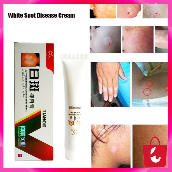 [100% Asli] Krim Vitiligo Salep Kurang Melamin Kulit / Menghilangkan Bercak Putih Pada Wajah Dan Kulit / Meratakan Warna Kulit /Menghambat Pertumbuhan Kulit Putih Kurang Melamin