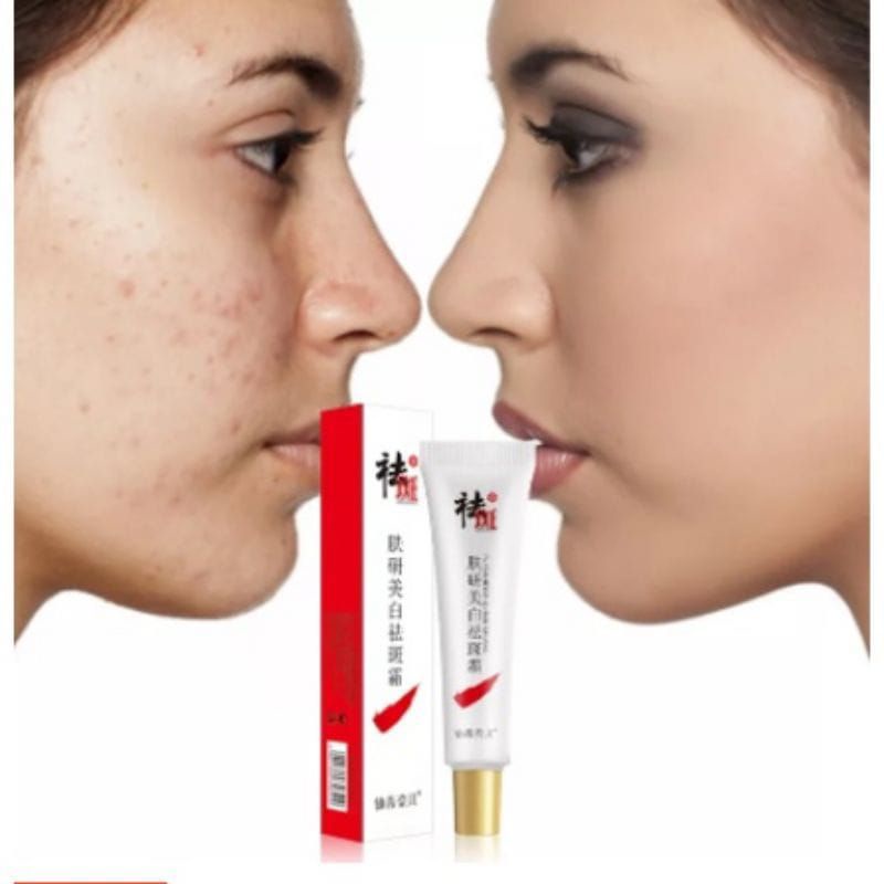pemutih krim flek hitam menghilangkan Melasma jerawat