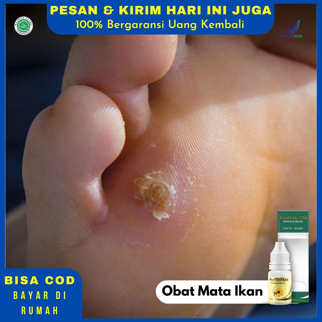 Obat Mata Ikan Kapalan Clavus Penebalan Radang Kulit Pada Tangan Kaki Jari - PROPOLIS SM