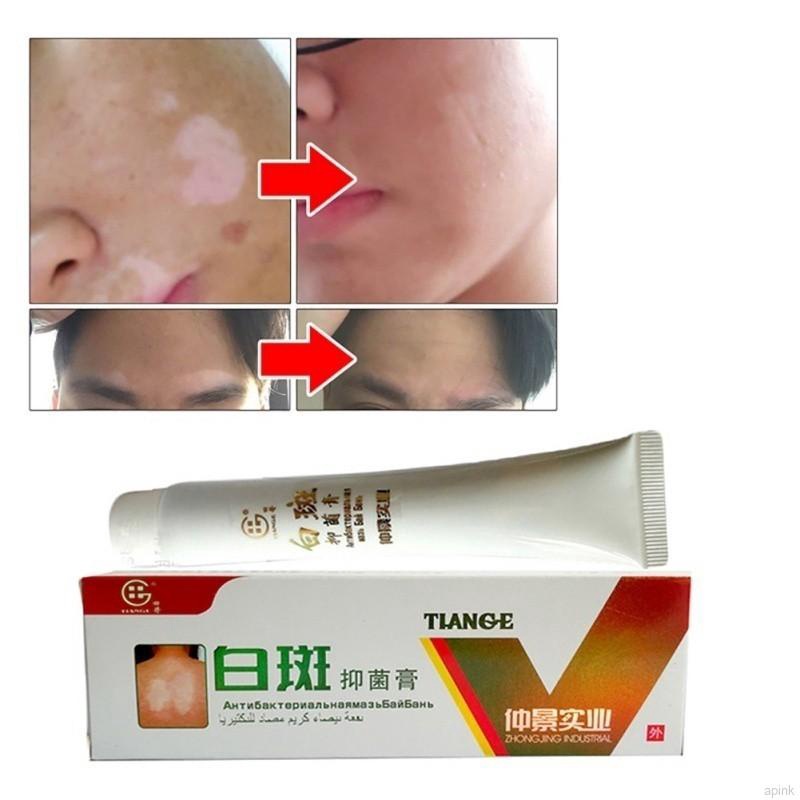 [100% Asli] Krim Vitiligo Salep Kurang Melamin Kulit / Menghilangkan Bercak Putih Pada Wajah Dan Kulit / Meratakan Warna Kulit /Menghambat Pertumbuhan Kulit Putih Kurang Melamin