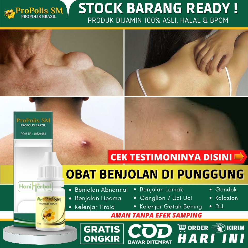 Obat Herbal Penghilang Benjolan Abnormal di Punggung 100% ASLI - Obat Benjolan di Punggung, Obat Ole