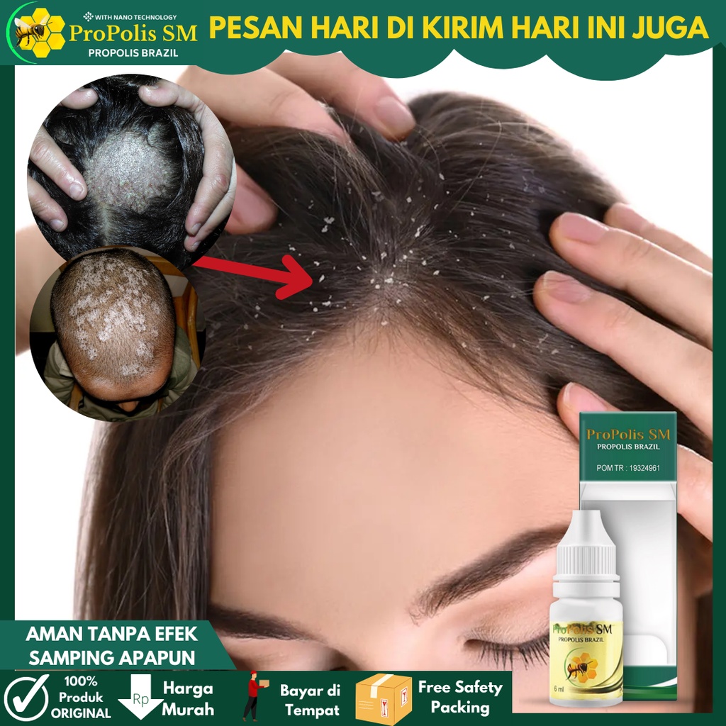 Obat Ketombe Rambut, Obat Jamur di Kepala, Obat Ketombe Kering/ Basah, Obat ketombe berkerak Parah B