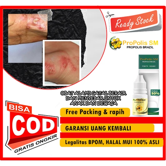 WISMAHERBAL - OBAT ALAMI GATAL BERAIR DAN MENYEBAR UNTUK ANAK DAN DEWASA - PROPOLIS SM