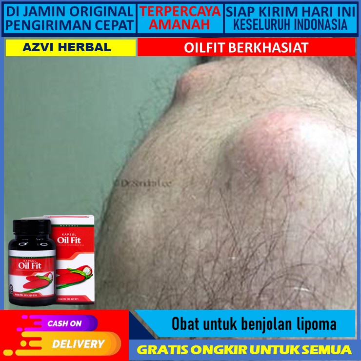 obat benjolan lipoma Obat Benjolan Lipoma Obat Lipoma Pengempes Benjolan Lipoma Penghilang Benjolan 