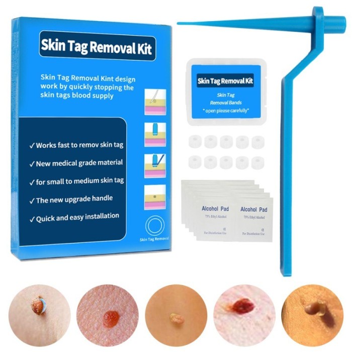 barokah gamis Auto Micro Skin Tag Remover Alat Penghilang Kutil Painless Removal Kit