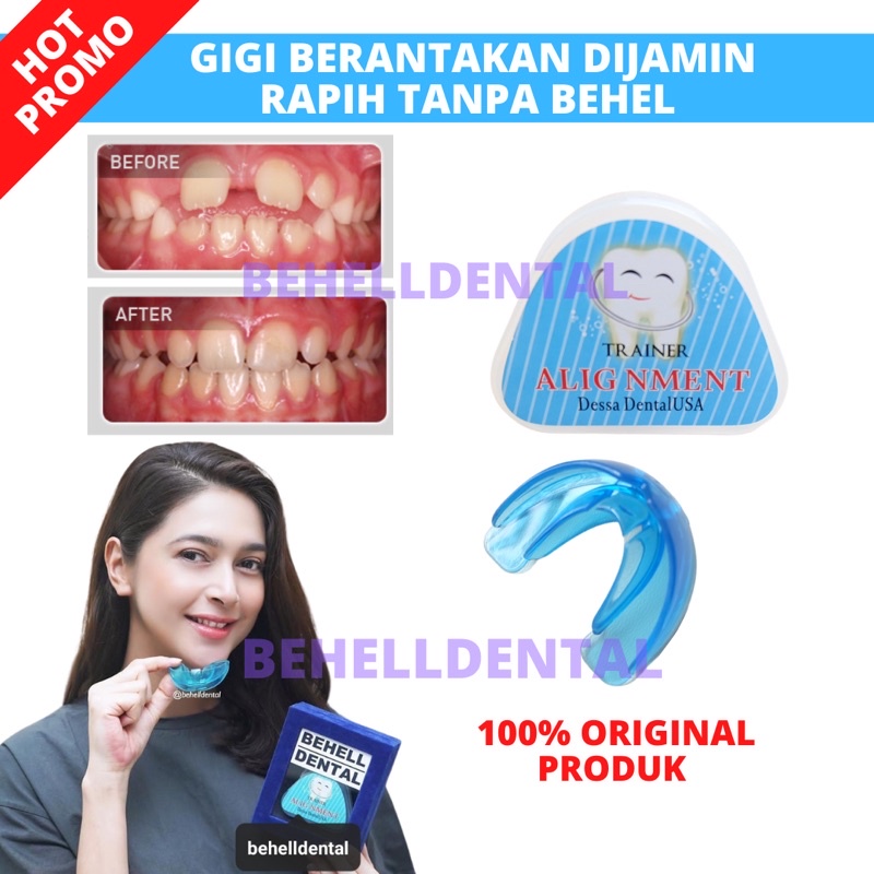 PERAPIH GIGI BEHELLDENTAL ORIGINAL / ALAT PELURUS TANPA BEHEL / TEETH TRAINER RETAINER ALIGNMENT 100% ORI ASLI - Dental Perata Gigi