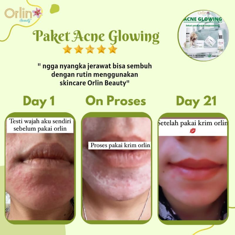 Miffglow - FREE GIFT Orlin beauty paket acne glowing orlin beauty paket acne platinum paket anti acne  original