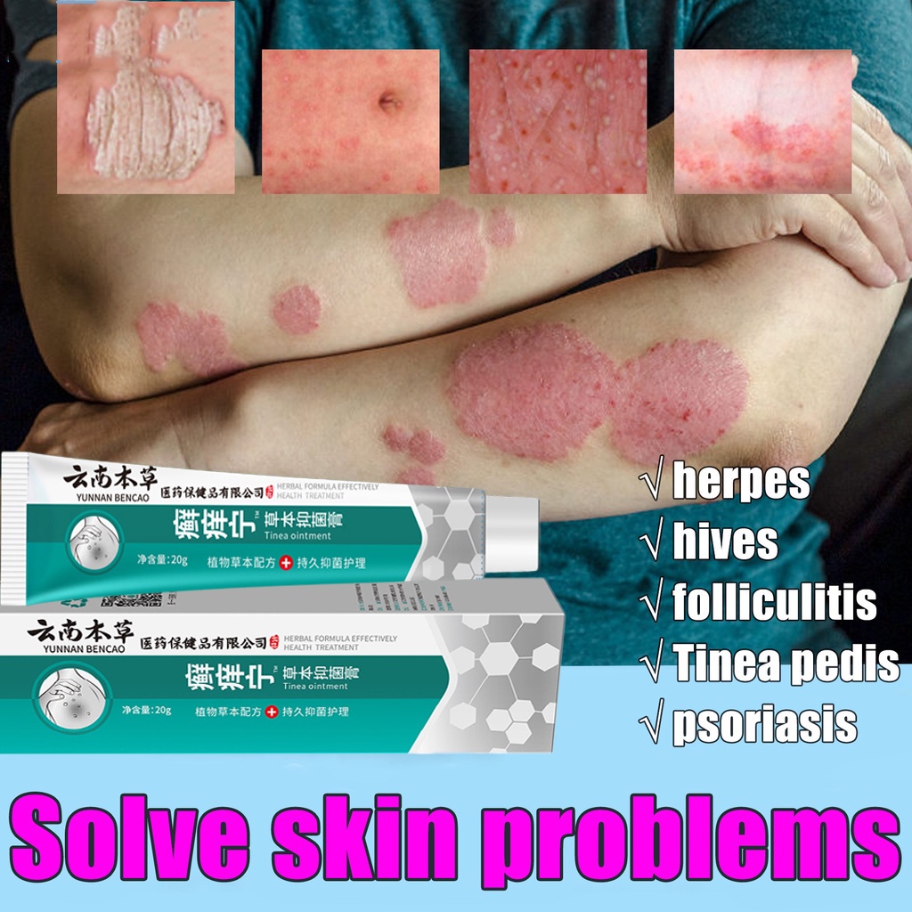 Salep Gatal Paling Ampuh Salep Eksim Salep Kulit Krim Psoriasis 20g Salep Psoriasis Mengobati Eksim 