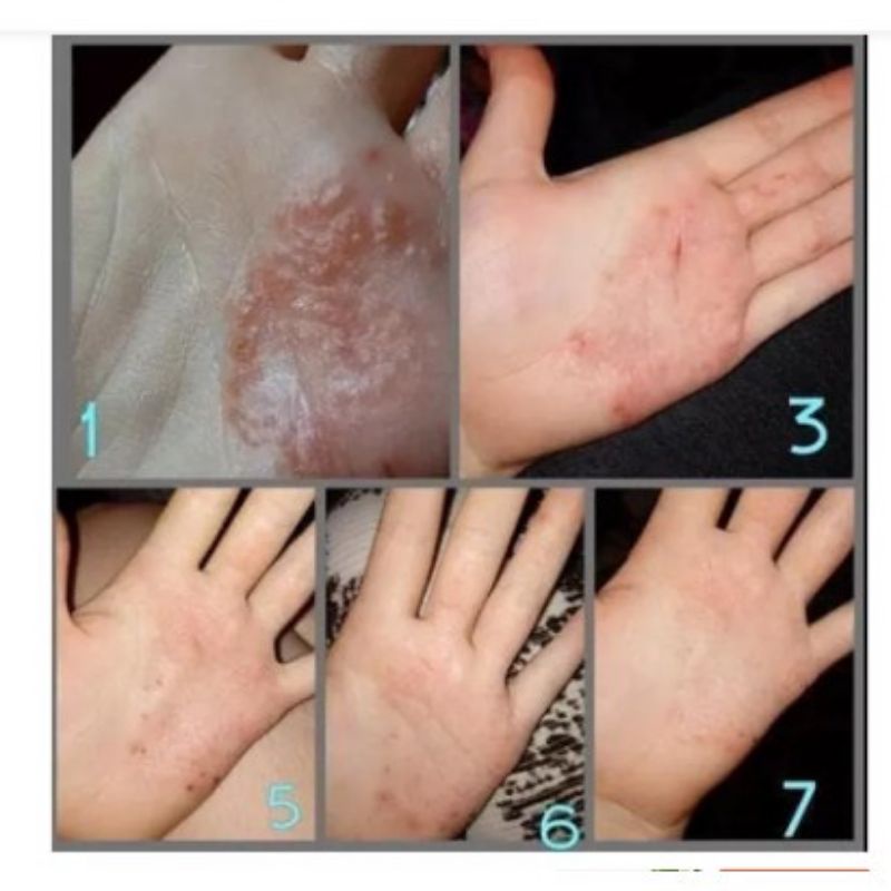 SALEP ZUDAIFU Original Proriasis Eksim Jamur Kurap Alergi Kulit Cream