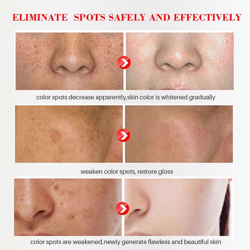 SISKALEY/YOUBUY 20g Whitening and Freckle Removing Cream Niacinamide Fade Pigmentation Melasma Brighten