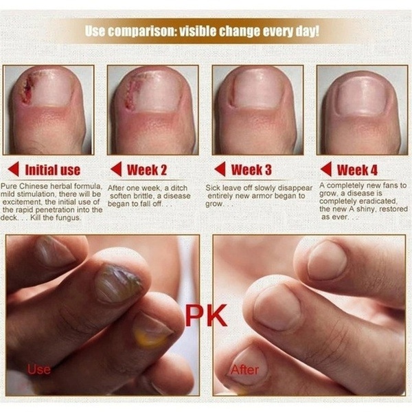 Krim perbaikan kuku Aman tidak sakit/Perawtan kuku Anti virus Mengatasi gatal Serum menghilangkan onokomikosis/Krim kuku jamur Krim perbaikan memperbaiki kuku jamur