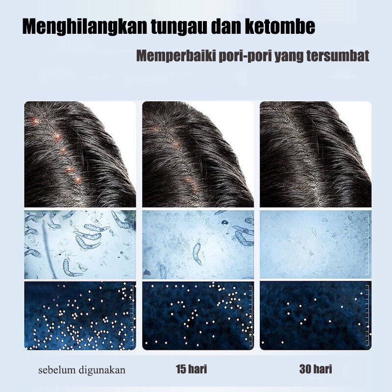 Sampo anti ketombe shampo rambut rontok 200ml 99% efek anti ketombe dari garam laut Mengurangi ujung bercabang Sterilisasi yang efisien dan anti ketombe Shampoo kutu rambut