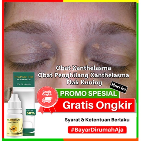 Jual Obat Xanthelasma Obat Penghilang Xanthelasma Flak Kuning Gumpalan Lemak Di Kelopak Mata