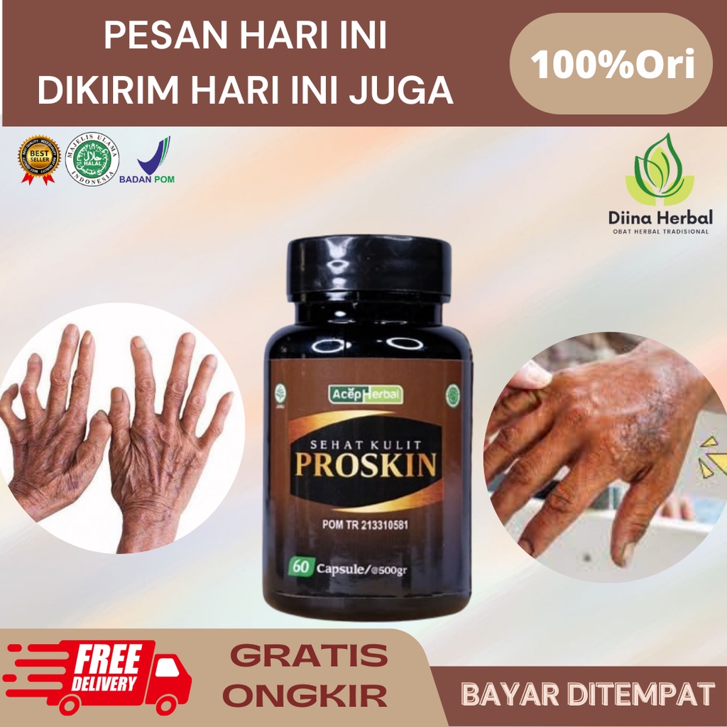 Obat Penyakit Kusta, Obat Kusta, Obat Kusta Kering, Obat Kusta Lepra, Obat Kusta Pada Lansia, Obat I