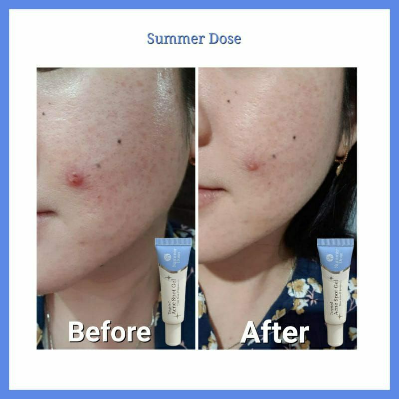 (SHARE IN JAR) SUMMER DOSE Acne Treatment Serum Acne Spot Gel Merawat kulit berjerawat tanpa bikin kulit kering