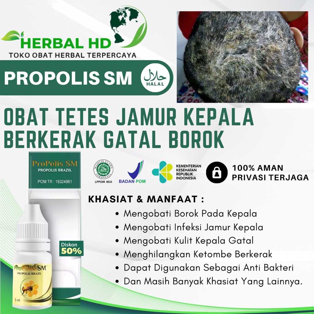 Obat Oles Tinea Capitis, Obat Kulit Kepala Berkerak, Ketombe Parah, Obat Gatal Kulit Kepala, Obat In