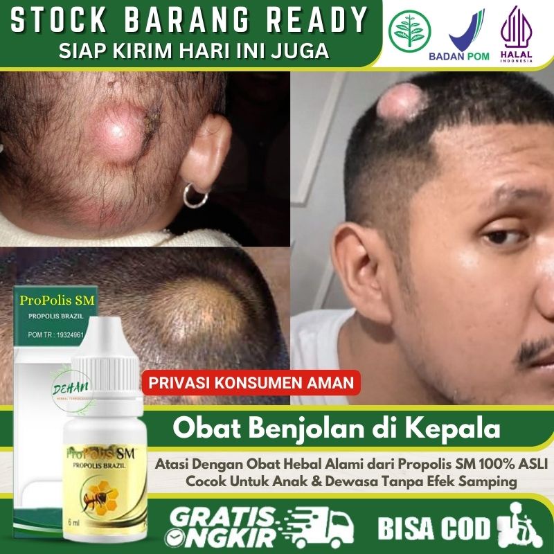 Obat Oles Pengempis Benjolan di Kepala 100% Herbal Alami, Penghilang Benjolan Abnormal di Kepala, Pe
