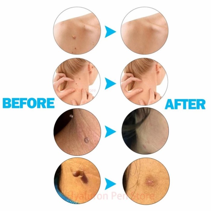 FMFIT Auto Micro Skin Tag Remover Alat Penghilang Kutil Painless Removal Kit