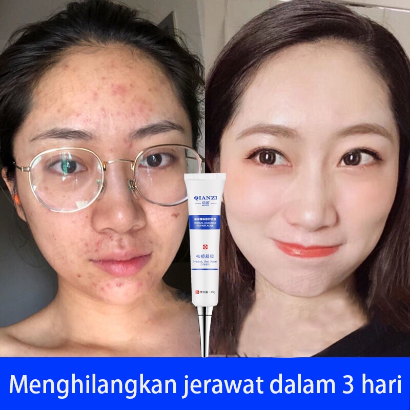 Serum Acne Obat Jerawat Obat Totol Jerawat 30g Herbal Obat Jerawat Dan Bekas Jerawat Obat Jerawat Dan Bekas Jerawat Paling Ampuh