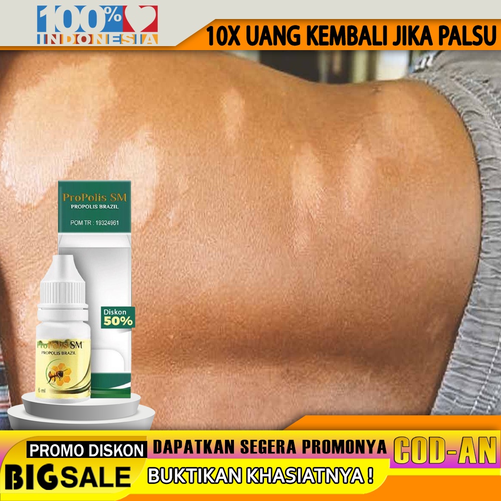 Jual Obat Kusta, obat kulit kusta, obat kusta basah, kering, Obat