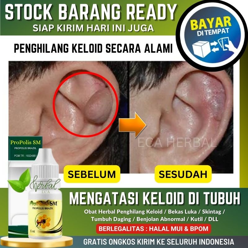OBAT KELOID DI DAUN TELINGA, MELENYAPKAN KELOID AKIBAT INFEKSI TINDIK TELINGA, LUKA BEKAS TINDIK, SA