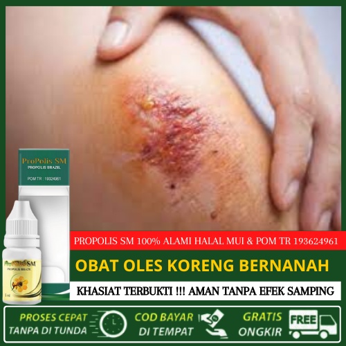 [Bukan Salep] Obat oles koreng bernanah, obat infeksi koreng di tangan dan kaki, pengering luka kore