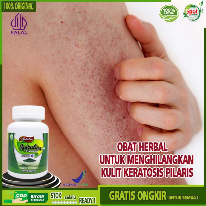 

BIG SALE Obat Penyakit Kulit Keratosis Pilaris,Obat Herbal Penyakit Kulit Ayam