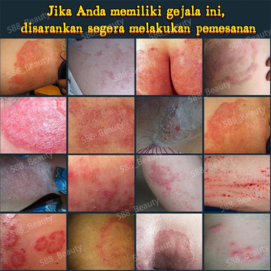 Salep gatal Salep eksim Salep kulit gatal Salep jamur kulit Obat salep gatal Obat salep psoriasis eczema cream salep gatal gatal