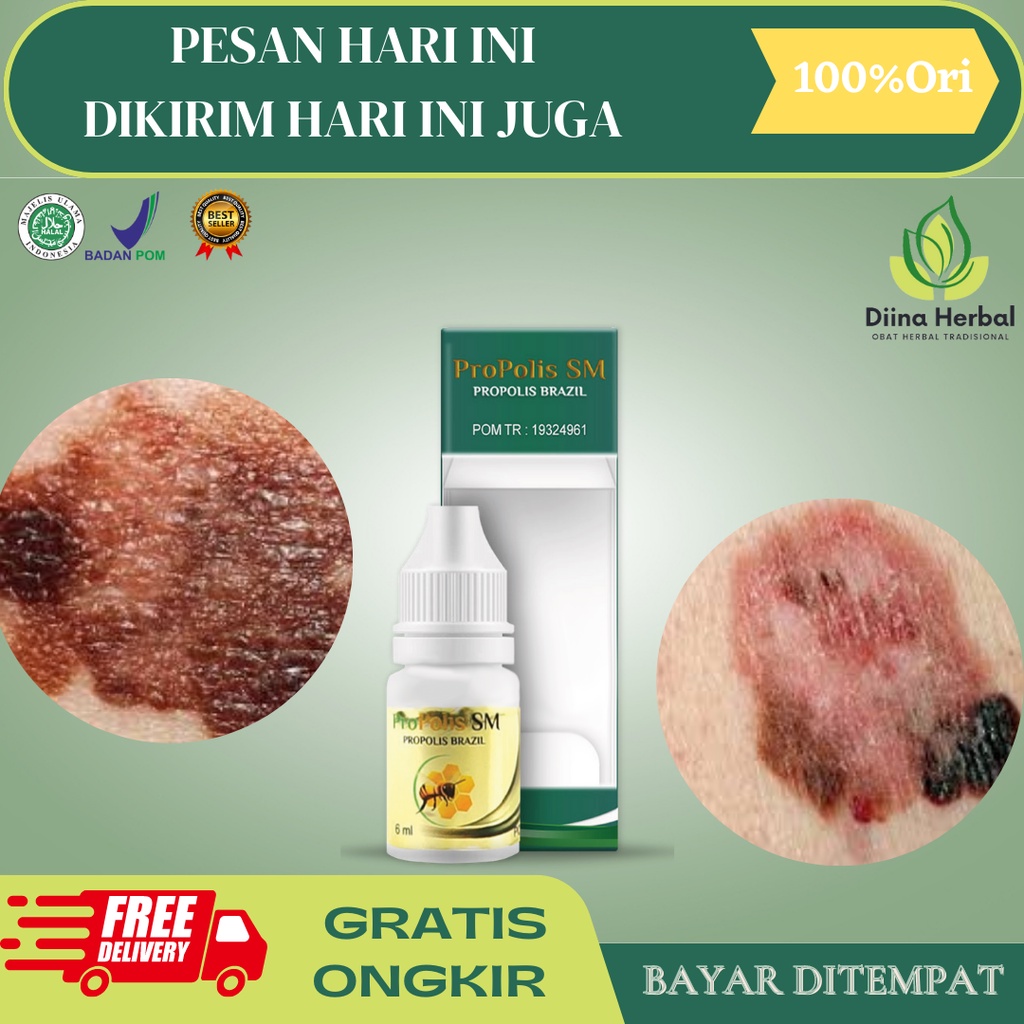 Obat Kanker Kulit, Obat Herbal Kanker Kulit, Obat Kanker Kulit Melanoma, Obat Benjolan Bercak Hitam 