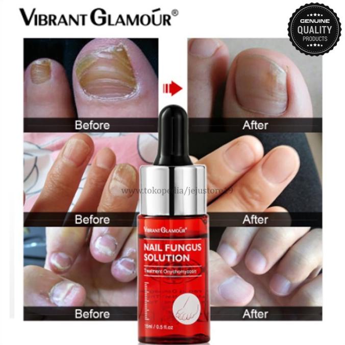 Vibrant Glamour Solusi Jamur Kuku