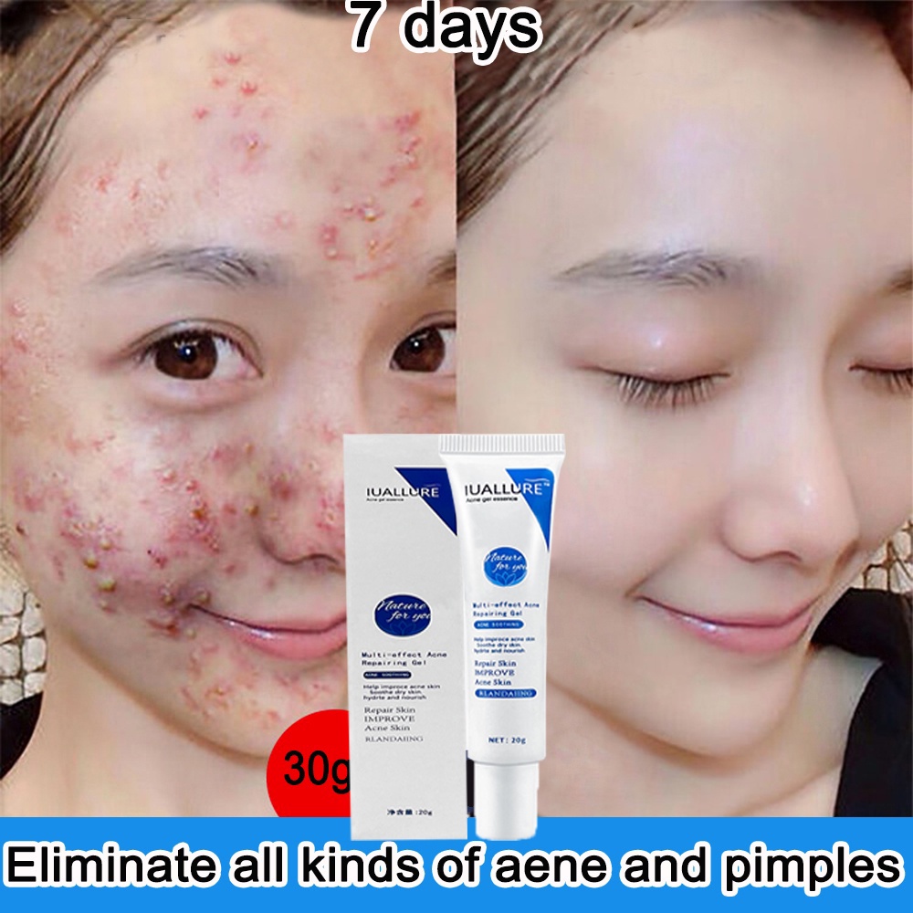 cream jerawat obat totol jerawat krim jerawat obat jerawat dan bekas jerawat Jerawat Removal of Acne Cream Untuk Pria dan Wanita Menghilangkan jerawat dengan cepat