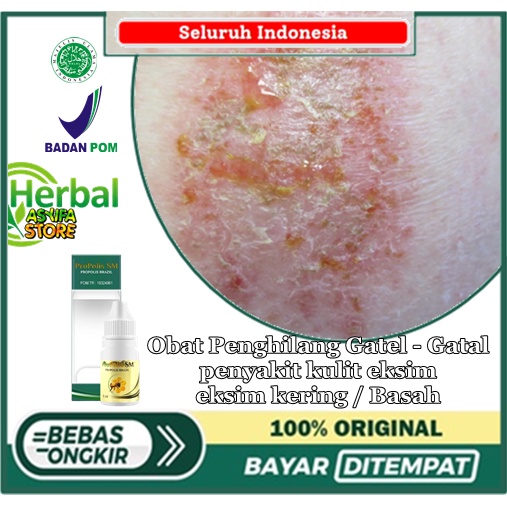 Obat Penghilang Gatel - Gatal & penyakit kulit eksim, eksim kering / Basah, dermatitis atopik, eksim