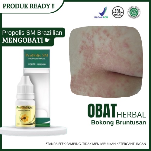 Obat Bokong Bruntusan, Jerawat Di Pantat, Folikulitis, Menghilangkan Bintik Hitam Di Bokong Dengan P