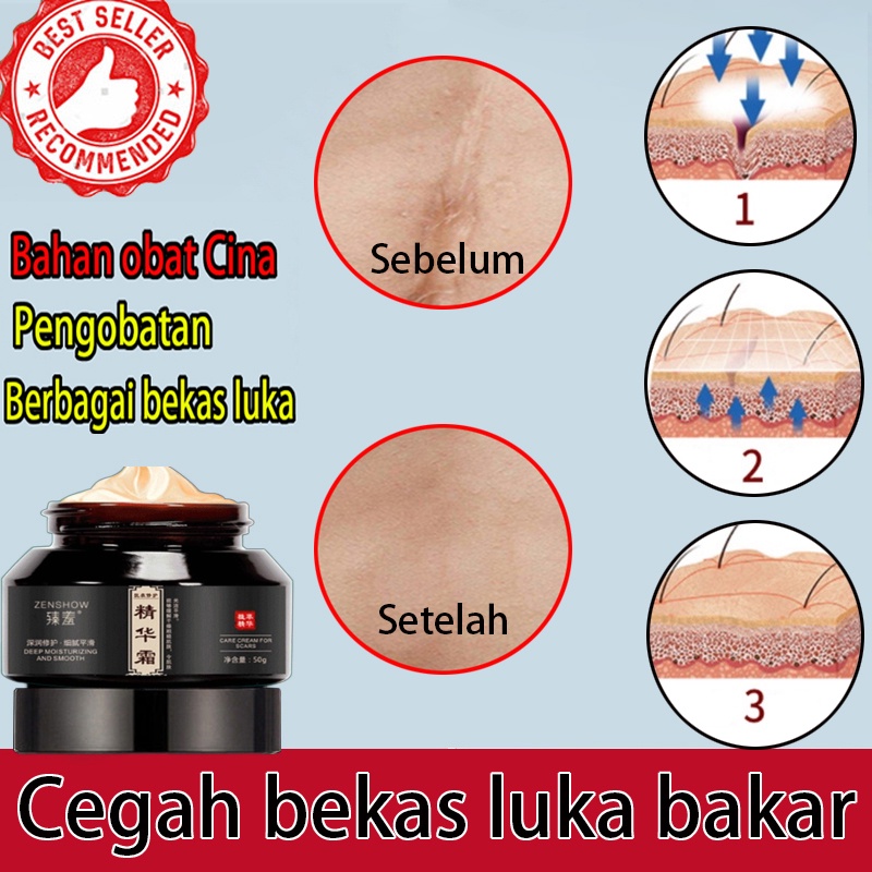 PENGHILANG BEKAS LUKA Original Penghilang Bekas Luka / Keloid ANTI SCAR Stretchmark 50 Gram Jerawat Krim Penghilang Bekas Luka Penghilang Bekas Luka Hitam Koreng Bekas Luka Bakar Bekas Operasi Flek Hitam