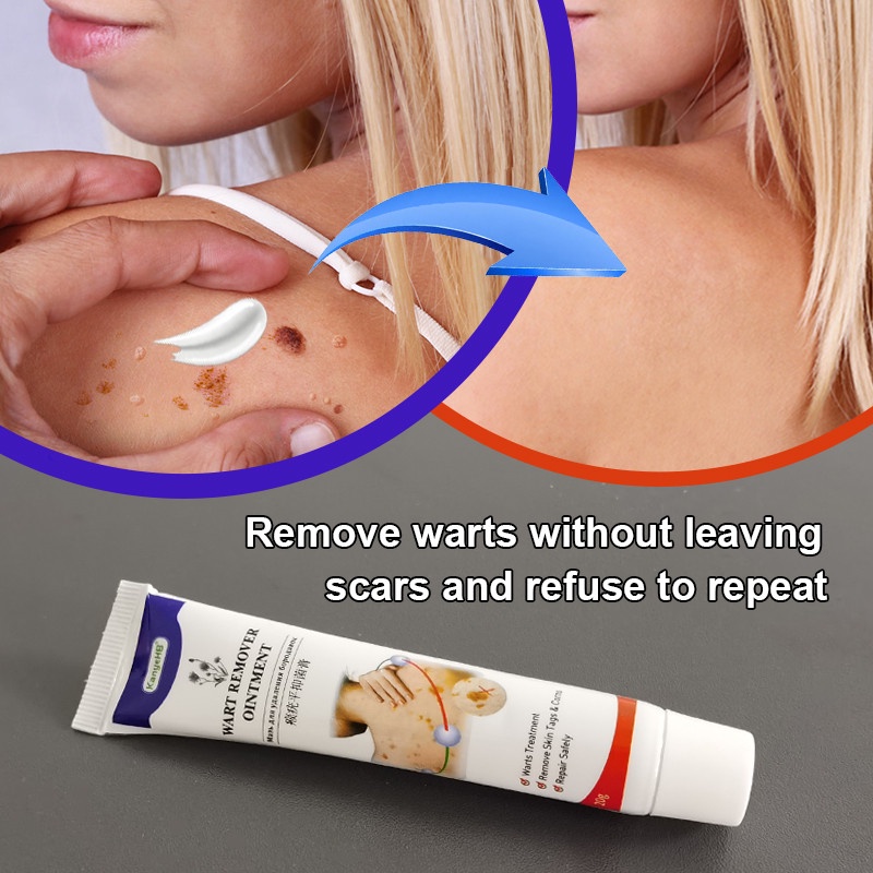 【COD】Warts Remover Antibacterial Obat kutil Obat tahi lalat penghilang tahi lalat penghilang papiloma wajah penghilang kutil Menghilangkan pada mata/wajah/leher/bagian tubuh