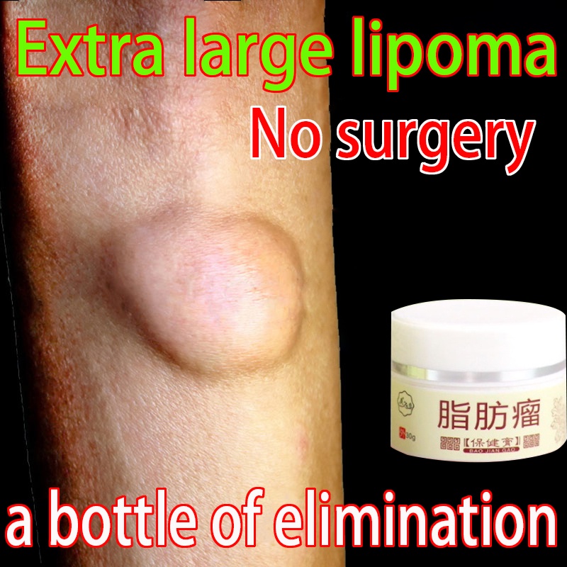 Jual Obat Oles Penghilang Benjolan Lipoma Krim Lipoma Obat Benjolan