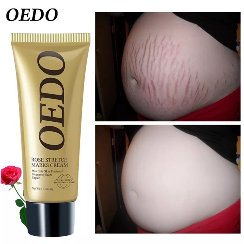 OEDO MAWAR PENGHAPUS STRETCH MARKS KRIM BERSALIN PENGHILANG BEKAS LUKA-40gr