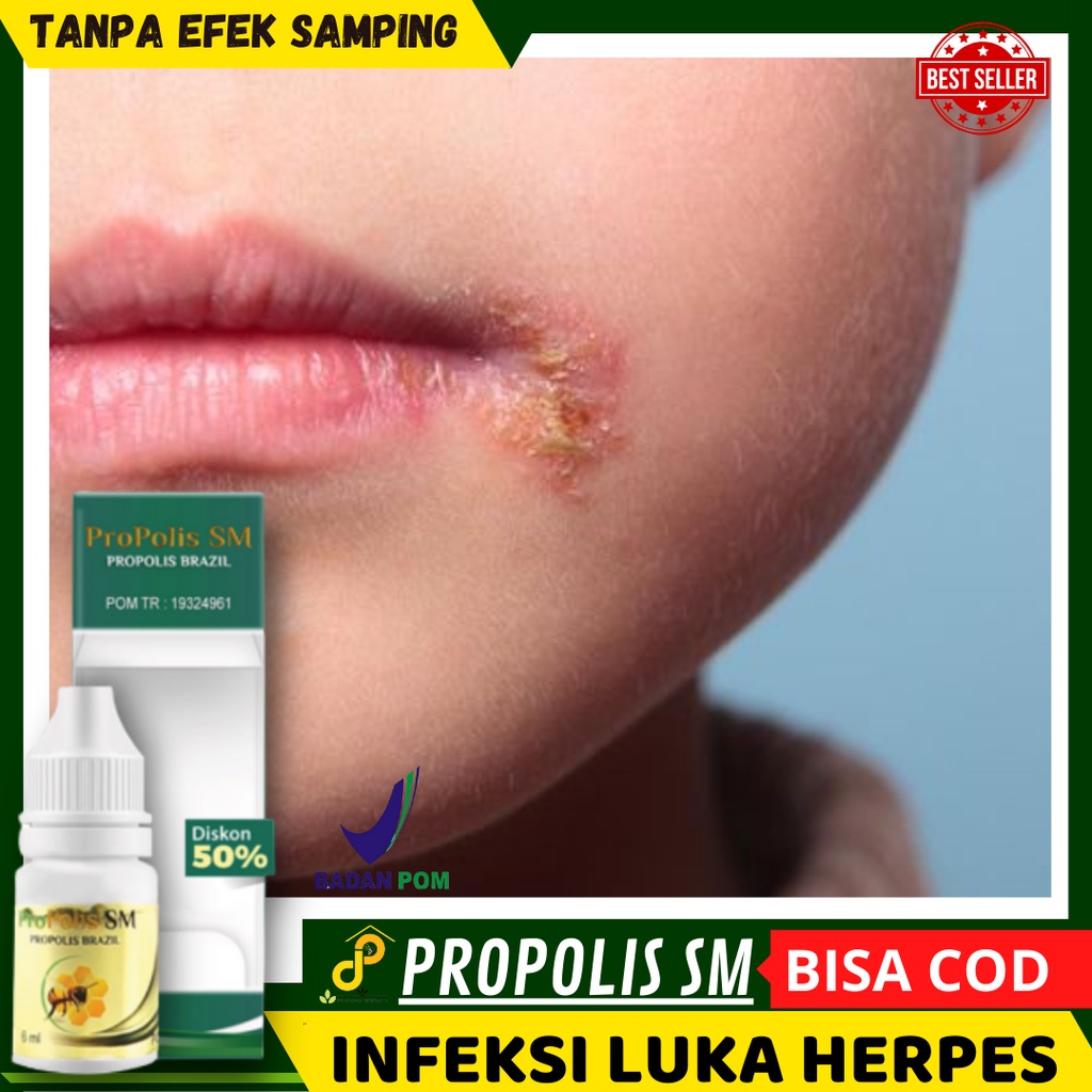 Obat Menghilangkan Herpes di kelopak mata, Infeksi Luka Herpes di Bibir, Herpes di Mulut, ruam Berai