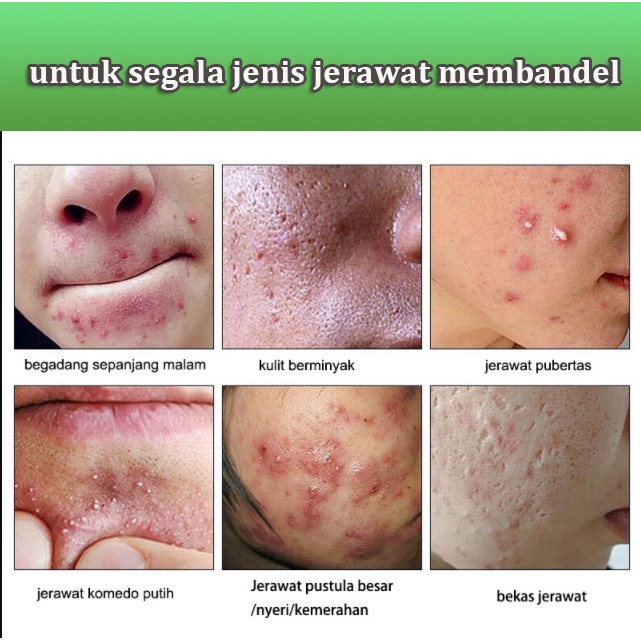 Krim Jerawat Pembersih Penghilang Jerawat Cream Jerawat Acne Cream 30g Membersihkan Kulit Secara Mendalam Menghilangkan Melanin Jerawat dan Bekas Jerawat Perawatan Kulit Unisex